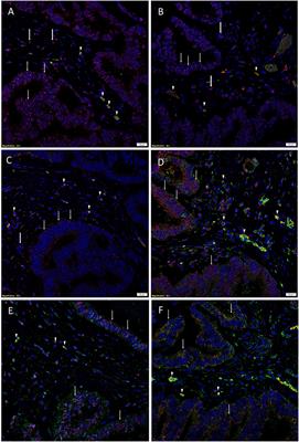 Characterization of Cancer Stem Cells in Colon Adenocarcinoma Metastasis to the Liver